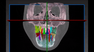 Dental segmentation