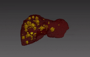 Liver Tumor Segmentation with Deep Learning by RSIP Vision