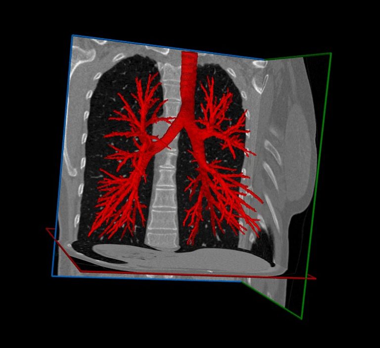 Lung Segmentation with Unmatched Precision for Lung Procedures