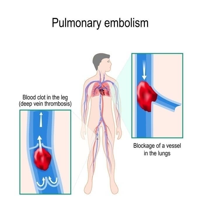 Detecting Pulmonary Embolism from CT Scan by RSIP Vision