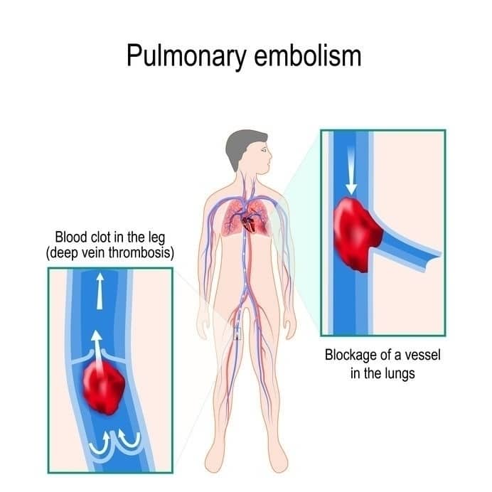 Pulmonary embolism