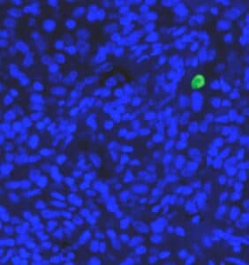 CTCs - Circulating Tumor Cells