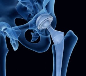 Total hip replacement