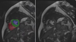 Cardiac MRI Heart Chambers Segmentation