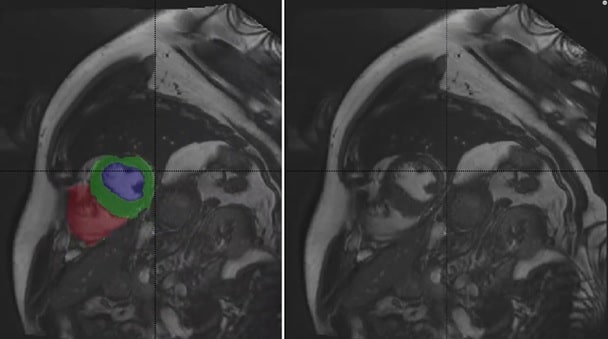 Cardiac MRI Heart Chambers Segmentation