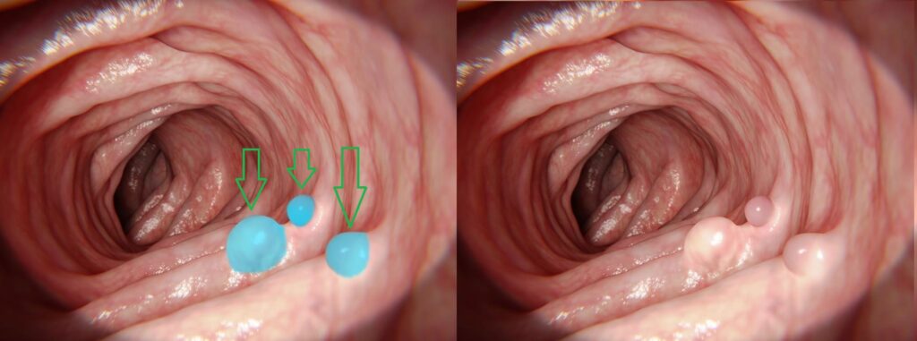 Endoscopy with cancer detection (2)