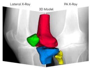 3D-Reconstruction-of-Knee