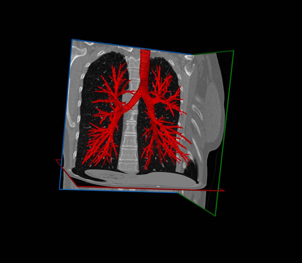 Airways segmentation with AI