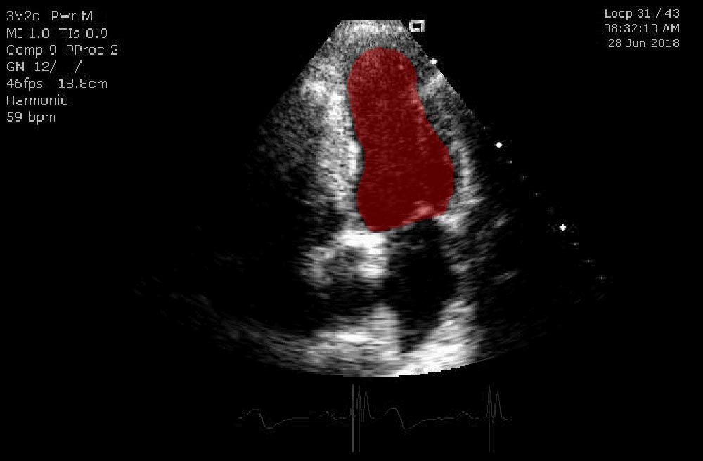 Ultrasound segmentation with AI