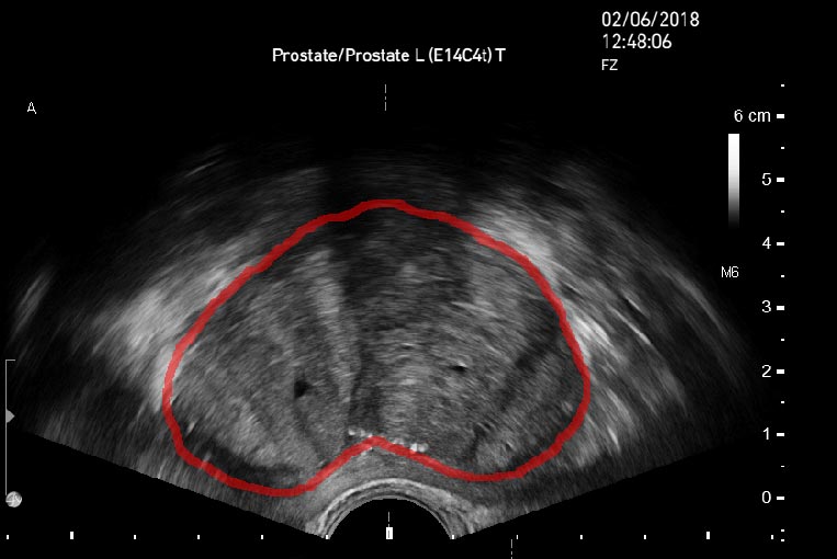 Prostate segmentation with AI