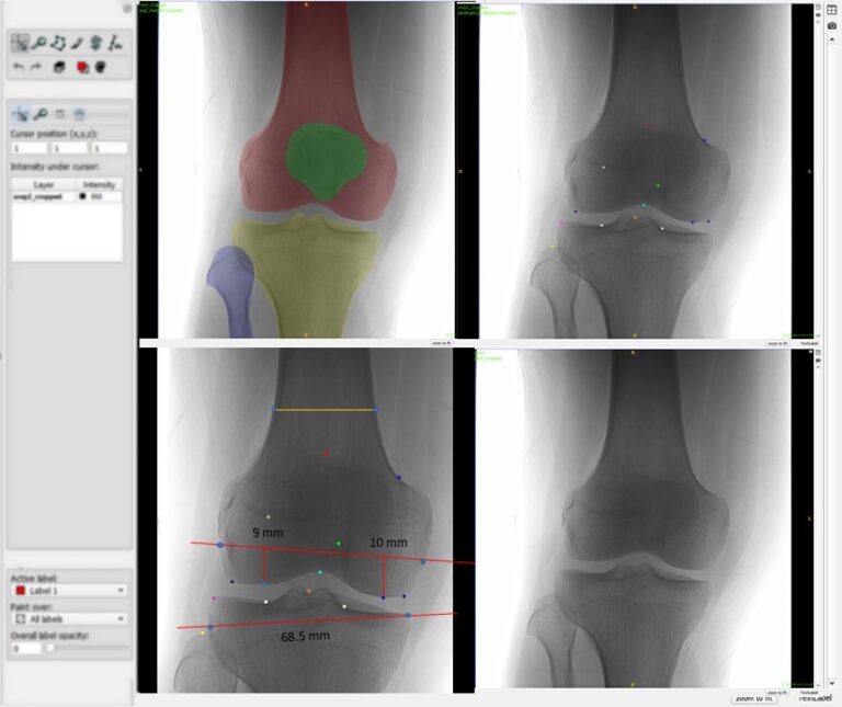 Knee X-ray