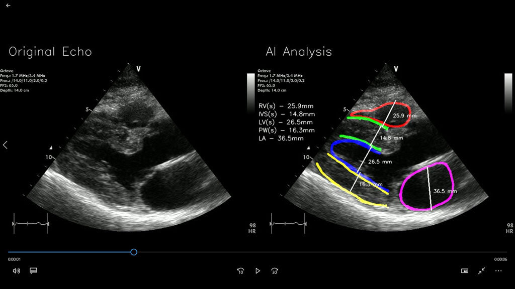 Point of Care Ultrasound Technology (POCUS) With AI