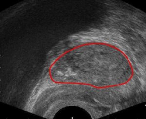 Segmented prostate gland