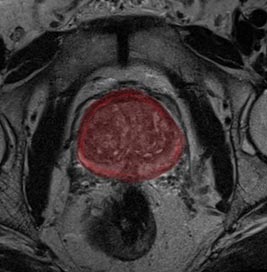 Segmented prostate gland from MRI scan