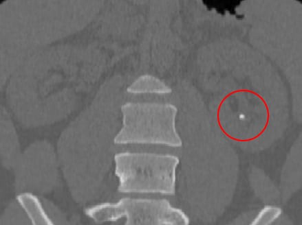 Urolithiasis, the formation of “stones” in the urinary pathway