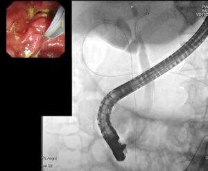 AI in Diagnostic ERCP