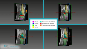 Automated Assessment of Cartilage Damage