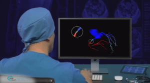 Coronary Intervention