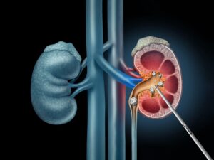 Percutaneous Nephrolithotomy