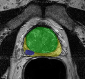 Prostate Tumor Segmentation