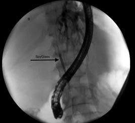 Type 4 cholangiocarcinoma