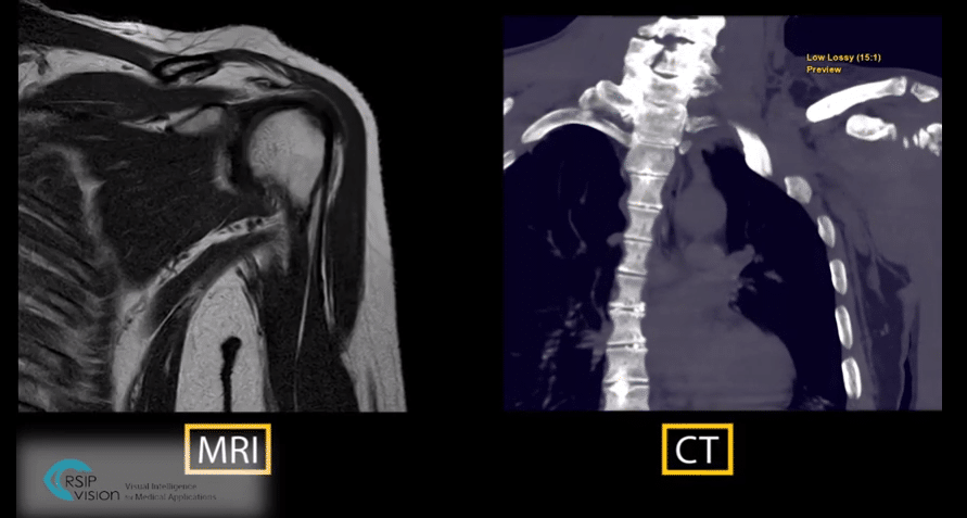 TSA Planning for MRI