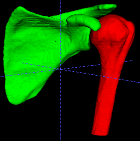 Arthroplasty