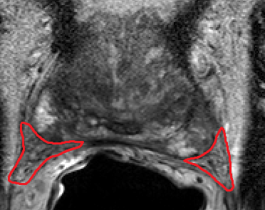 Tissue Sparing in urology