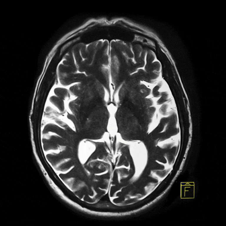 MRI - AI-Assisted Brain Surgery