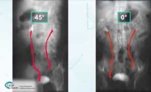 Ureter Reconstruction 2d3d