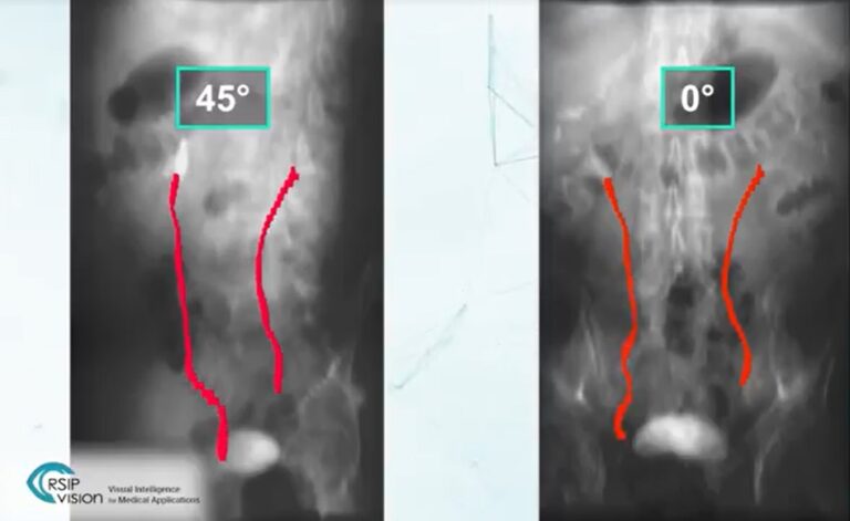 Ureter Reconstruction 2d3d