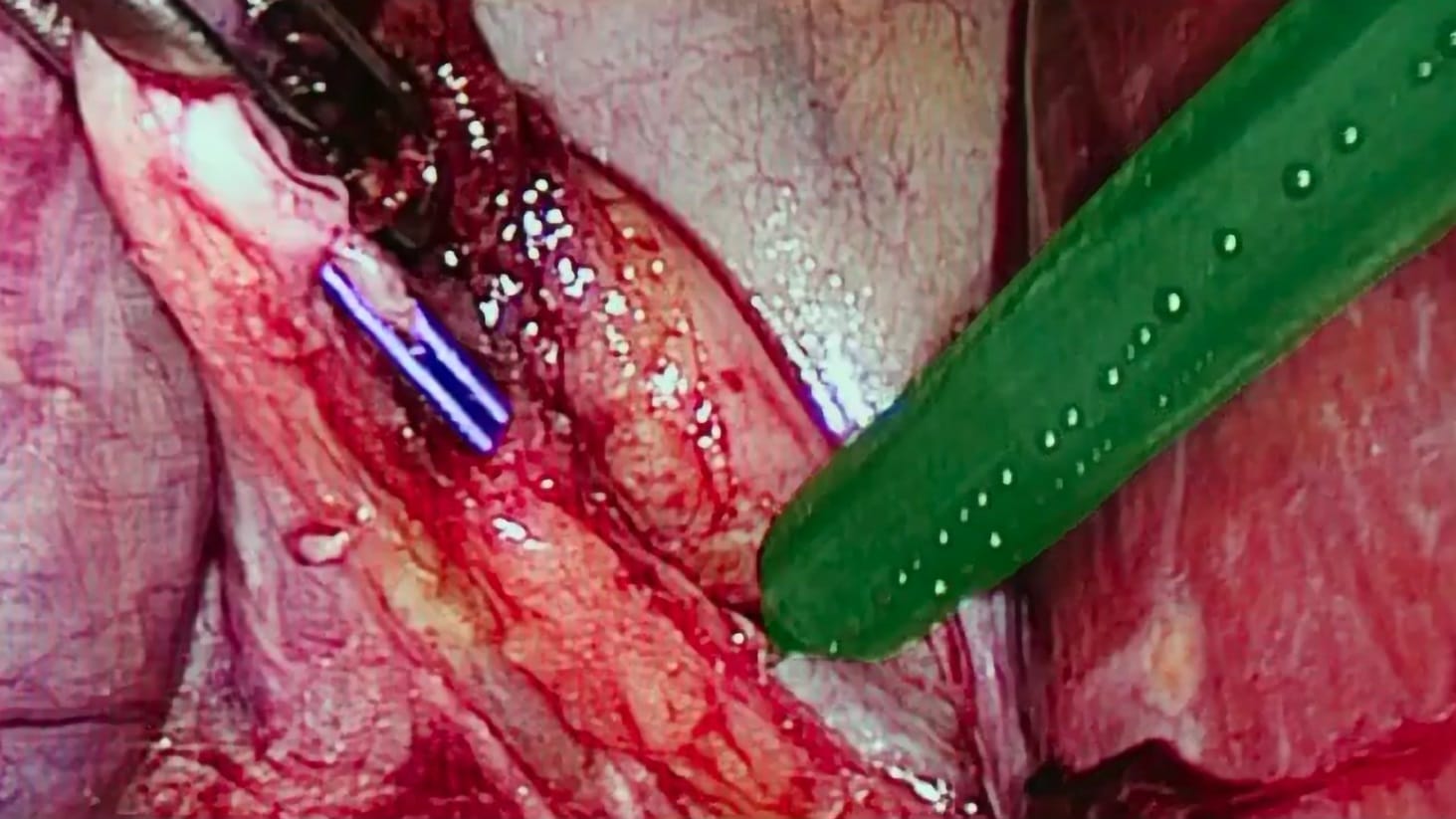 Surgical Video Analysis screenshot