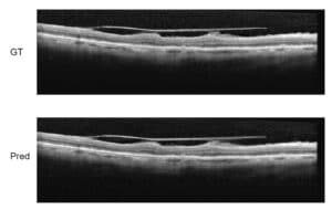 Super-Resolution in OCT images