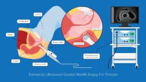 AI-Assisted Prostate cancer diagnosis