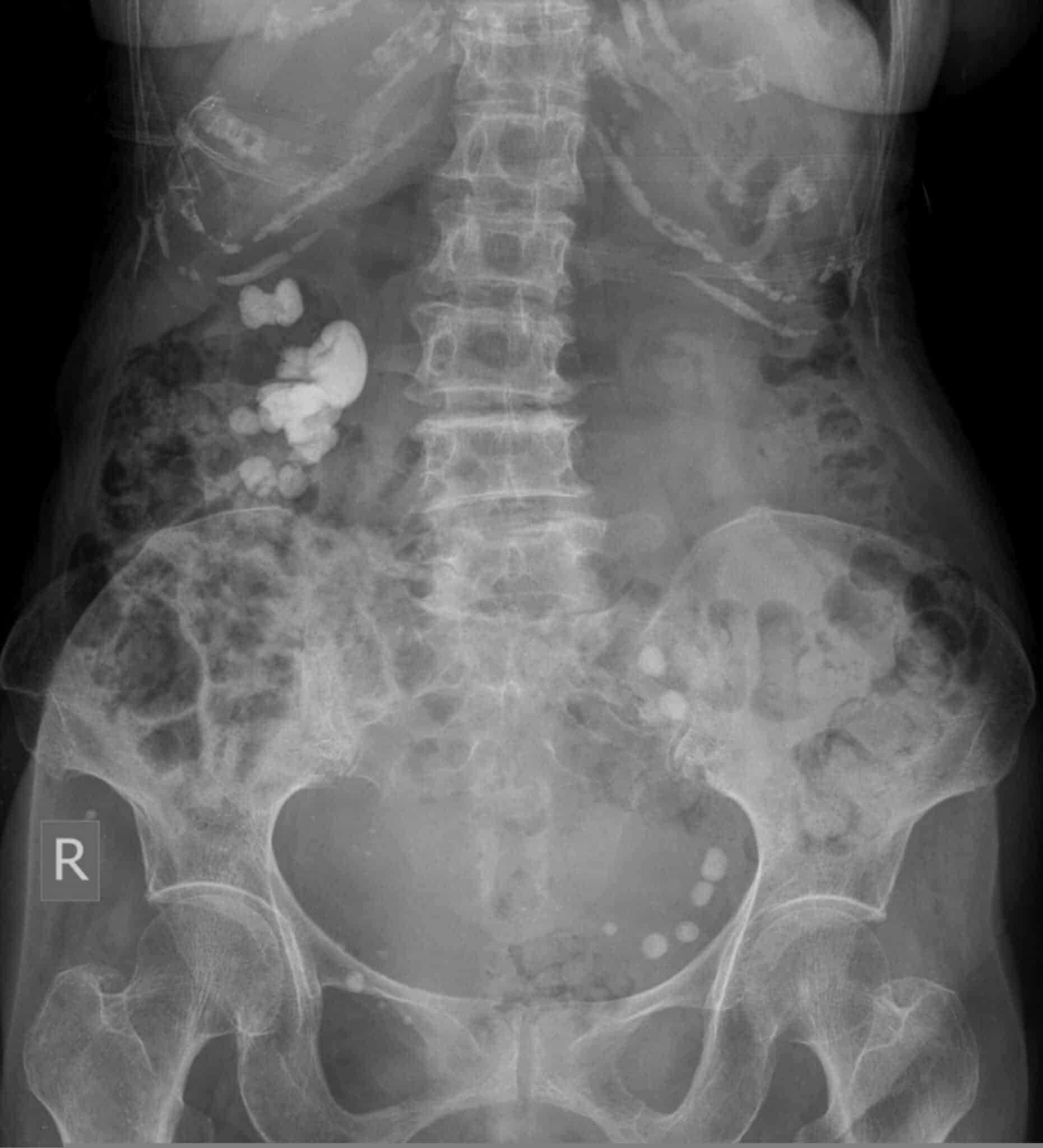 Nephrolithiasis, Abdomen x-Ray Renal Stone