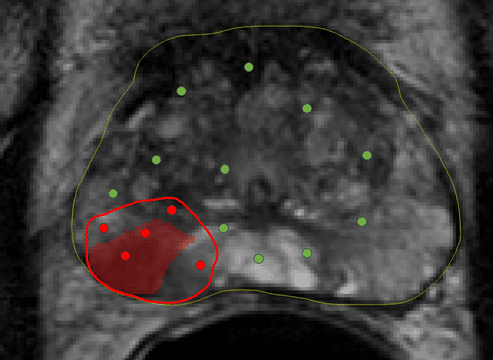 Ablation map based on MRI & biopsy core