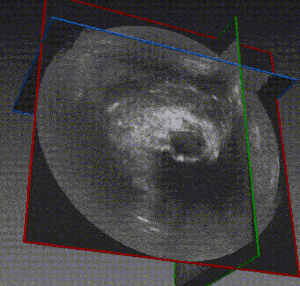 Pre-Op MRI structures overlayed on top of real-time ultrasound feed