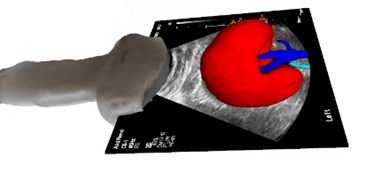 Extracorporeal ultrasound with real-time 3D fused kidney model
