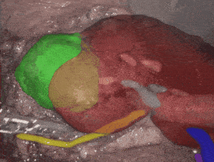 Kidney model with pathologies overlaid on real-time video stream