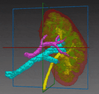 A segmentation of kidney structures out of a multi-phase CT