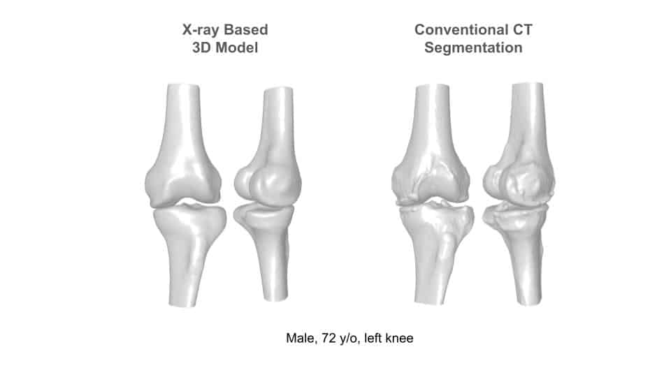 XPlan’s high-fidelity X-ray based 3D knee model